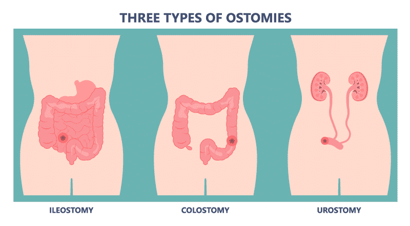 Ostomyfit - Control y confort en tu vida #ostomía #colostomia #ileostomia  #ostomizados #estomas #ponunabolsaentuvida Ostomyfit